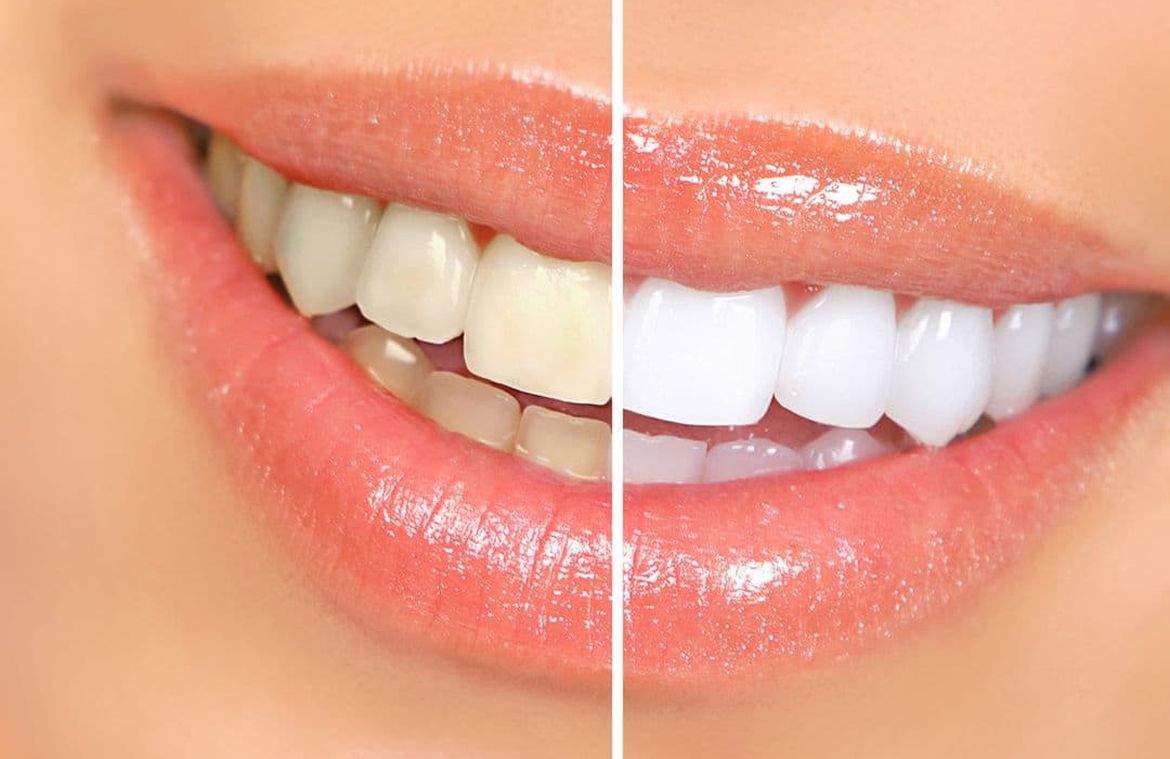 Spalato dental Izbjeljivanje zuba