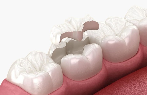 keramičke plombe Split