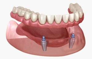 Proteza na lokatorima ili precki Proteza na lokatorima ili precki Split