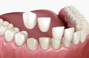 ljuskice za zube Split Dental Spalato zubne ljuskice