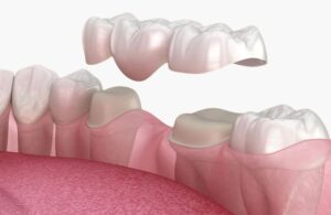 zubni most Keramički Most Split