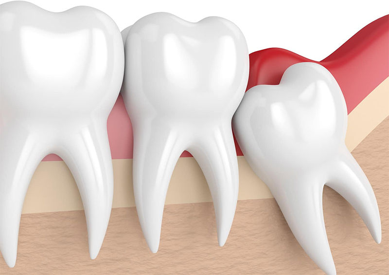 Vađenje Umnjaka Split