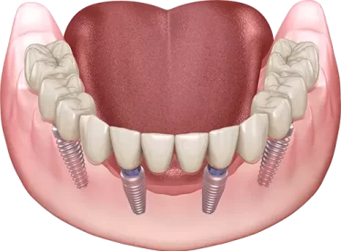 All On 4 sa cirkonskim mostom Spalato Dental