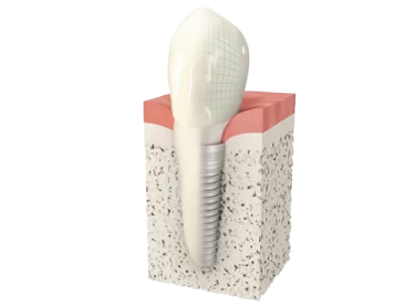 Dentalni implantat Spalato Dental