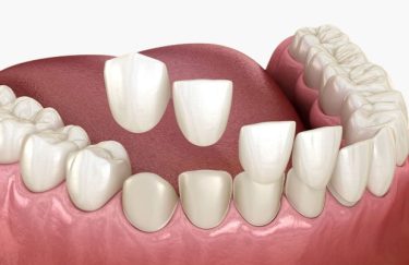 ljuskice za zube Split Dental Spalato zubne ljuskice